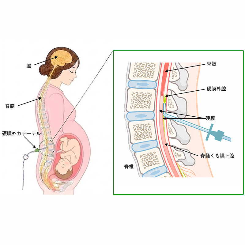硬膜外麻酔法とは